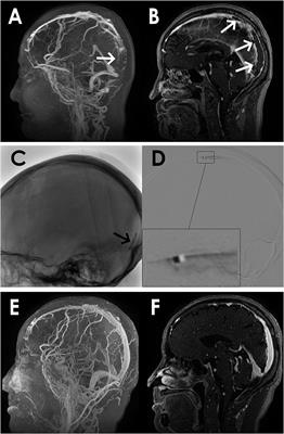 Balloon-Assisted Thrombectomy and Intrasinus Urokinase Thrombolysis for Severe Cerebral Venous Sinus Thrombosis